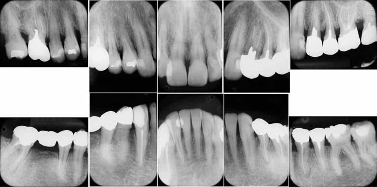 Nonsurgical Recovery of Interdental Papillae 143 Fig. 2 Dental X-ray at first visit Moderate horizontal bone defects were apparent in molar region, but no bone defects in central incisor region.