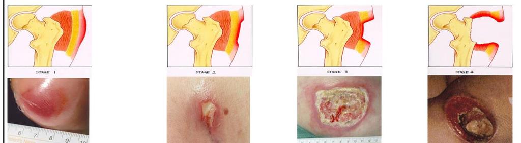 Pressure ulcer Stage 1 Stage 2 Stage 3 Stage 4 Nonblanchable erythema of intact skin Partial thickness skin