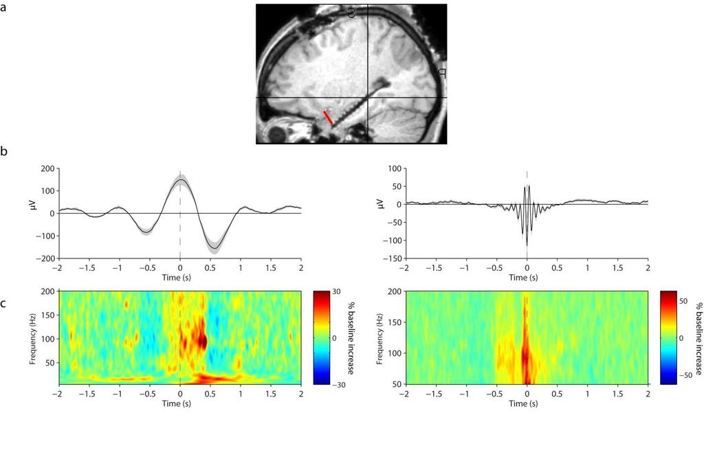 Supplementary Figure 10 Event-locked analysis of hippocampal PAC after re-referencing hippocampal data against the most anterior (11 participants) or lateral (1 participant) contact on the same depth