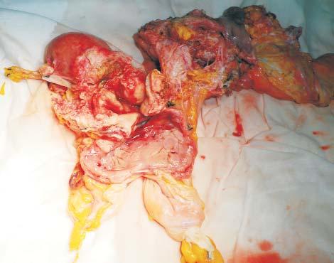 (4,5,6) While in cases presenting postprocedural vesicovaginal fistulas a conservative treatment or urinary reconstruction can be performed, when it comes to vesico-vaginal fistulas associated with