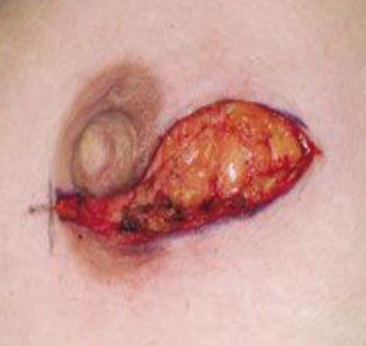 This type of incision is useful when a surgical approach