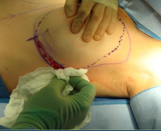 SKIN INCISION Inframammary incision. Skin incision is carried out at the lateral third of inframammary fold; in this area scar is practically invisible.
