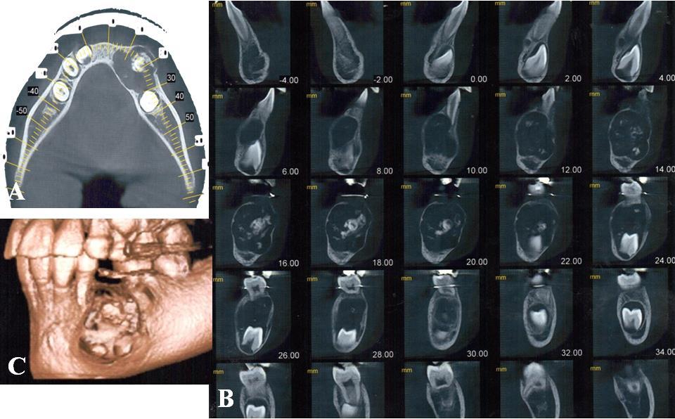 Figure 3 Axial (A) and sagittal (B) views reconstructed from cone beam computerized tomography (CBCT) of the lesion.