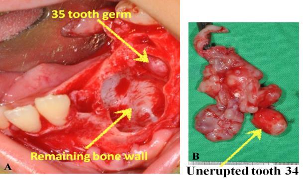 (C). Figure 4 The lesion was enucleated, and teeth 73, 75, and 34 were all extracted (A).