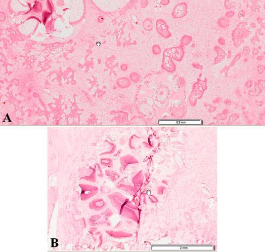 Figure 5 The decalcified section of the surgical specimen showed areas of cell-rich mesenchymal stroma, cords, and
