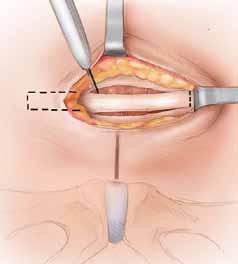 the urethra is compressed during increased abdominal pressure.