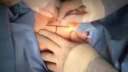 WATCH A VIDEO! Rectus fascia pubovaginal sling by Mickey M. Karram, MD, and Dani Zoorob, MD Courtesy of International Academy of Pelvic Surgery 4 ways to watch this video: 1.