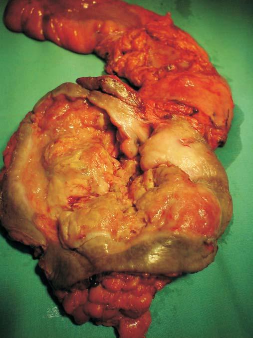 cimen of the resected squamous cell carcinoma and rectum L.p.