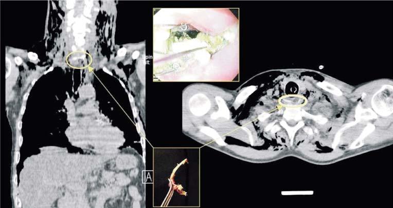 E.A. Toma et al Figure 1. CT and Upper Endoscopy findigs esophageal ulceration of approximately 2 cm diameter was also visualized.