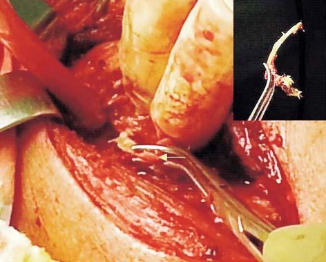 The Surgical Management of Acute Esophageal Perforation by Accidentally Ingested Fish Bone A Case Report Figure 3.