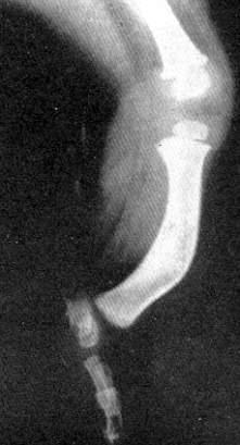 anomalies in the femur and knee laxity Foot deformity: valgus, absent lateral rays, coalitions (tarsal 50%,