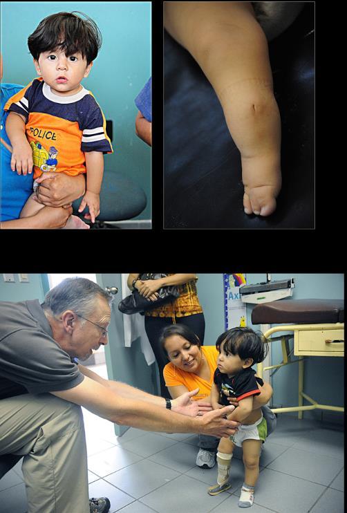 ANTERIOR MEDIAL BOW 3 year old boy with fibula hemimelia Notice dimple over the tibia and 3 toe foot 5 main problems with the