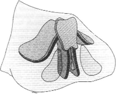 Aesth Plast Surg (2008) 32:136 142 141 Fig. 12 Shield graft (Sheen, 1975) Fig. 15 Costal cartilage graft harvest Fig. 13 Anchor graft (Juri, 1979) Fig.