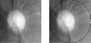 Retinal Fundus Image 2. DETECTION OF THE OPTIC DISK The detection of the optic Disk in the human Retina is the most important factor.