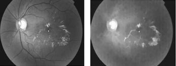 S PRAVEENKUMAR: FEATURE EXTRACTION OF RETINAL IMAGE FOR DIAGNOSIS OF ABNORMAL EYES is nex