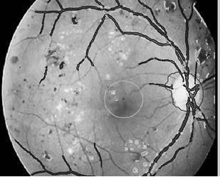 The results are encouraging and a clinical evaluation will be undertaken in order to be able to integrate the presented algorithm in a tool for diagnosis of diabetic retinopathy.
