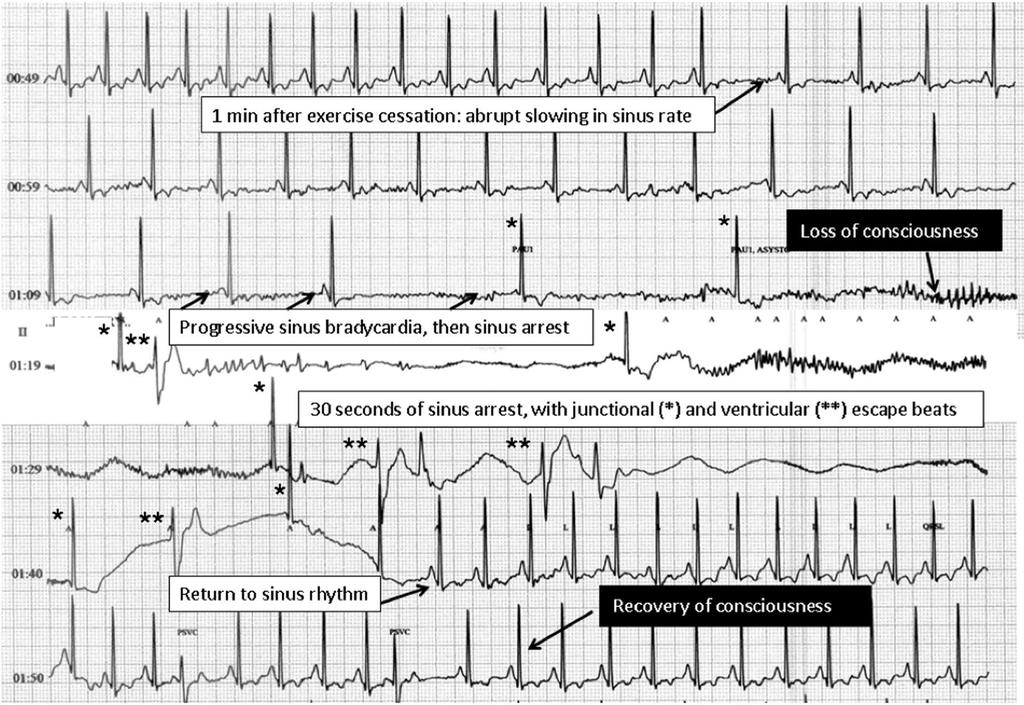 27yo Lacrosse player with syncope after exercise, negative tilt,