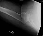 National inpatient sample 2011 66,485 shoulder arthroplasty procedures identified 33%