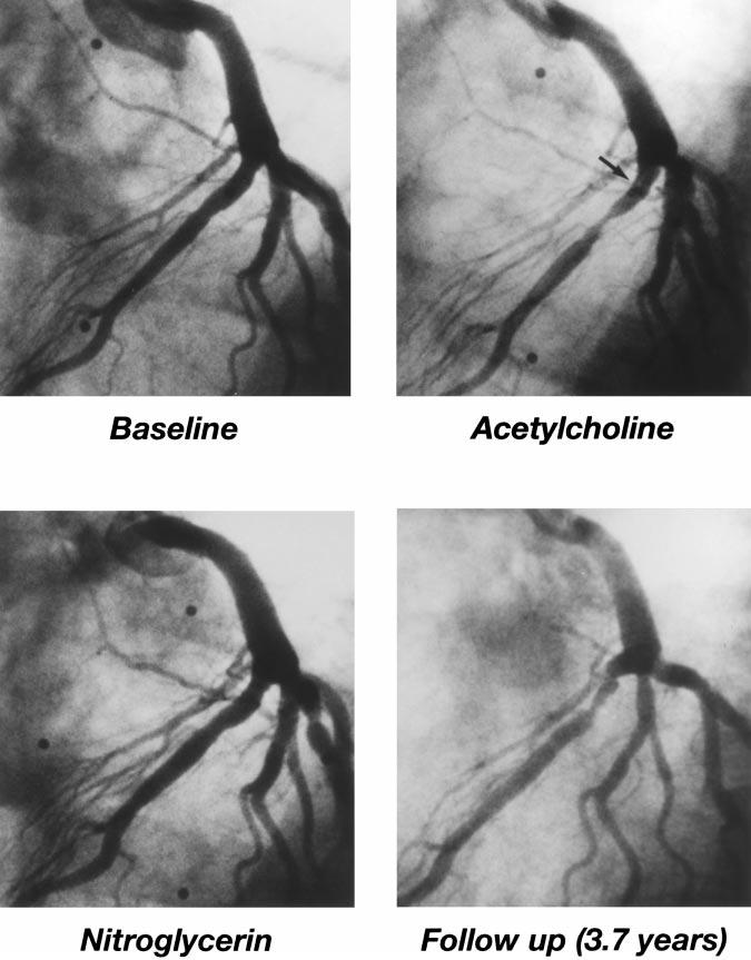 1904 Circulation April 25, 2000 Figure 3. Coronary vasoreactivity and atherosclerotic disease progression.