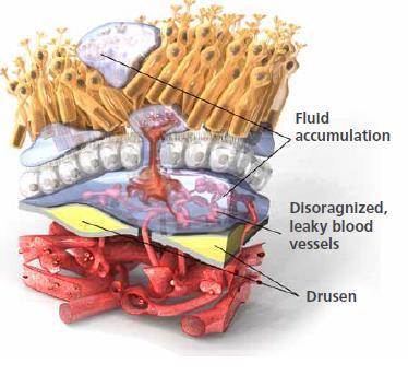 10-15% with drusen will progress to this Inflammatory and neovascular mediators (from drusen formation) invite choroidal vessels to grow into and beyond the fragmented membrane Fluid and blood