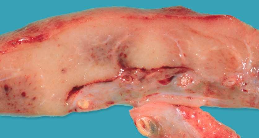 Renal allograft removed for end-stage kidney allograft failure The kidney is shrunken, the