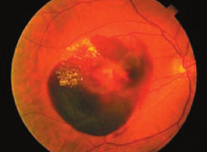 The development and progression of AMD to severe visual impairment is related to heredity and environmental factors, especially smoking.