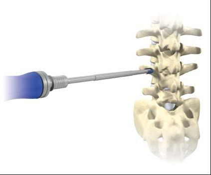 Screw Selection Select the proper screw. The screws are self-tapping and range from 4.5 mm to 8.5 mm in diameter to fit all anatomic variations encountered during spinal stabilization procedures.