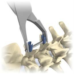 Compression & Distraction Compression or Distraction may then be performed at the surgeon s discretion. Compression is accomplished using the Vertebral Implant Compressor (09.0667).