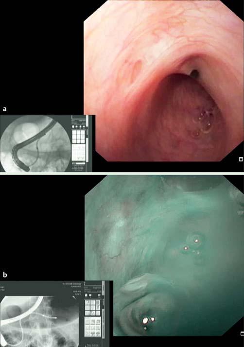 Review 745 Dual-operator mother-baby cholangioscopy Anchoring balloons may also involve a specific risk as, in an animal study, overinflation of the anchoring balloon resulted in biliary perforation
