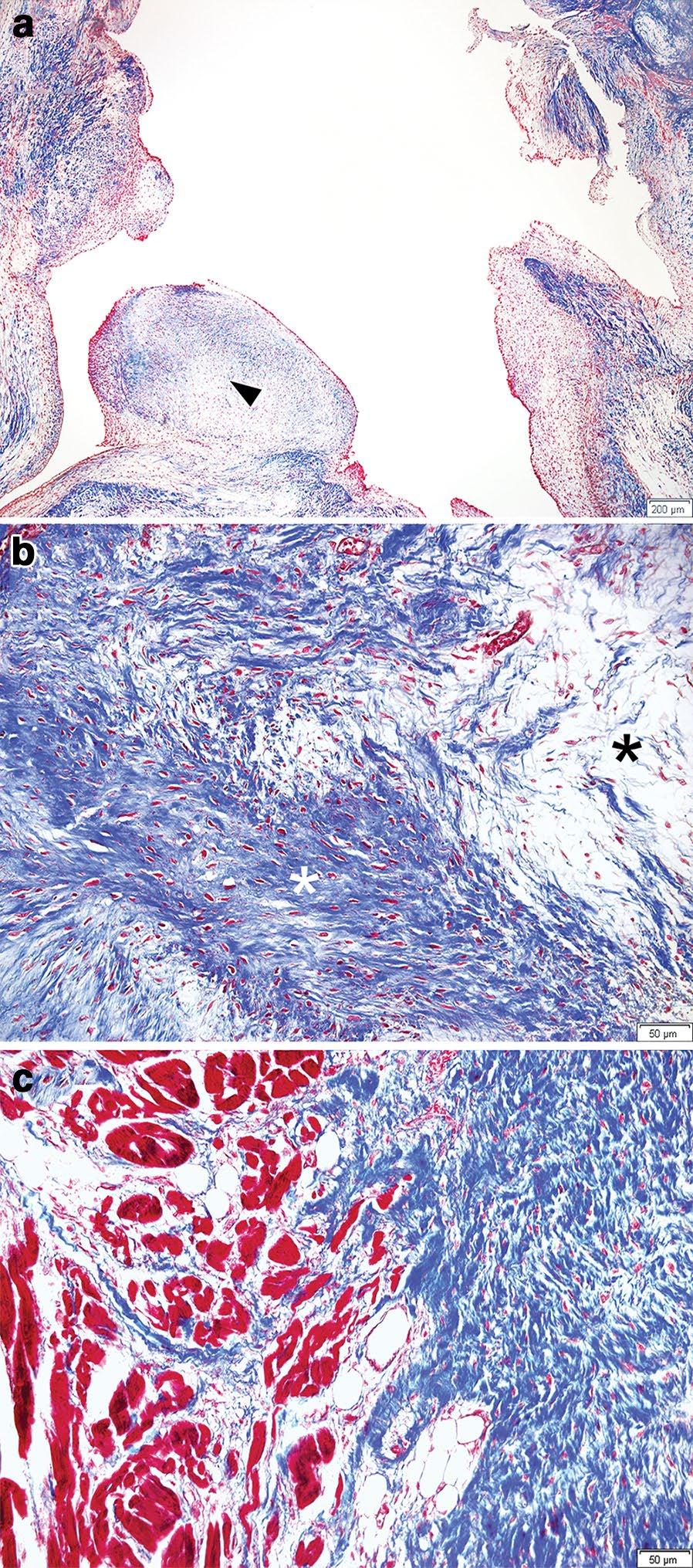 Page 5 of 7 Fig. 4 Histopathologic findings of the pulmonary valve stained with Masson s trichrome protocols.
