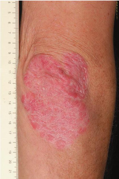 Chapter 1 - General Introduction 1.2 Epidemiology and clinical presentation of psoriasis Psoriasis is a common disease, affecting 1,5-3% of the world s population.
