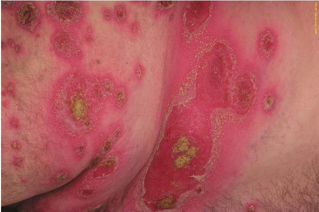 (figure 2) The pustules can be localized (pustulosis palmoplantaris) or generalized 4,5.