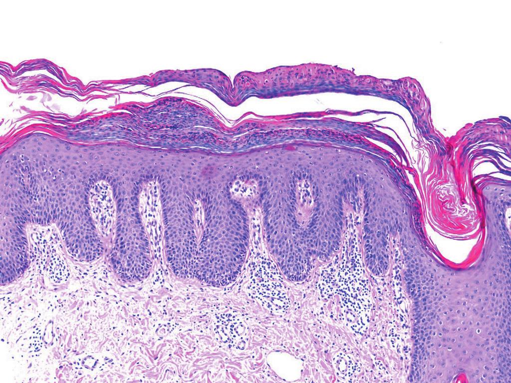Several gene loci have been linked to psoriasis.
