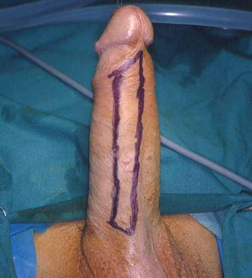 In penile urethral strictures due to: Trauma Instrumentation