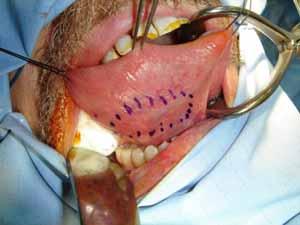 Harvesting mucosal graft from the tongue Advantages Two grafts available in all patients Donor site scar is concealed The harvesting procedure