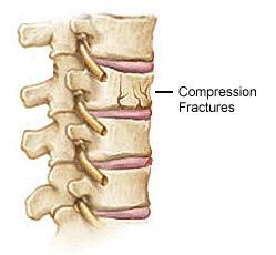 OVERVIEW An almost sure way of treating spinal fracture is now within the reach of common people. Spinal Fracture need not result in a sure deformity or a disability any more.