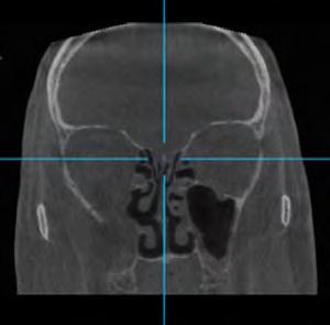 CBCT Predicted Marginal Mandibular Resection of a Patient with Oral Squamous Cell Carcinoma Drago B. Jelovac, DMD, MSc, MSIII, PhD student, resident MFS, Prof. Vitomir S.