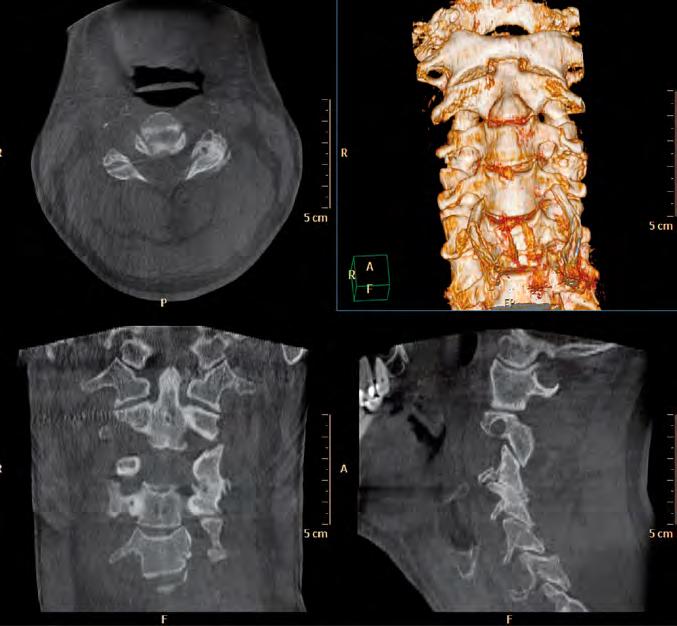 Discussion of sample case Discussion of sample cases Case 1: A middle-aged male patient was presented with symptoms of radiating pain in the left cervical region radiating towards left upper limb.