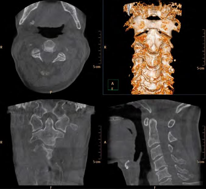 He consulted his neurosurgeon who referred the patient directly to CBCT of the cervical spine.