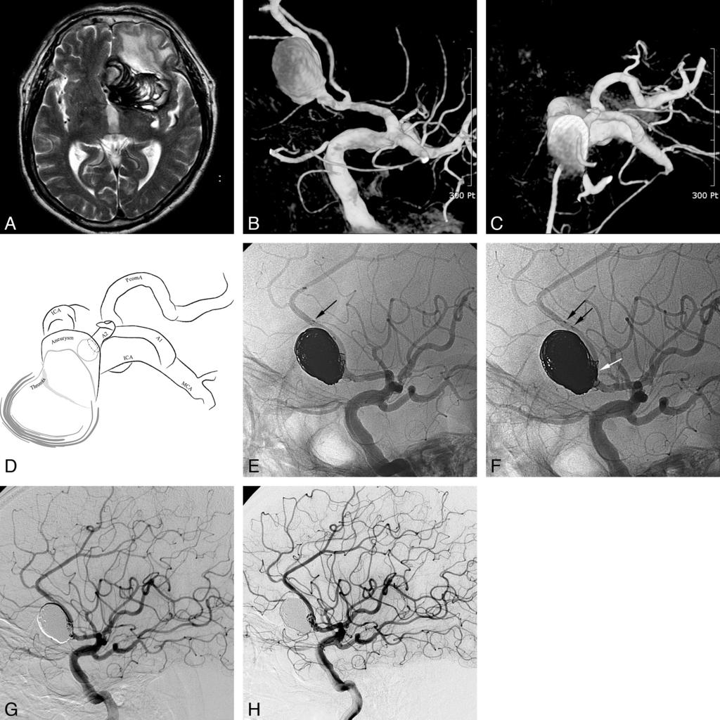 Fig 1. A 71-year-old man (patient 3) presenting with a giant aneurysm with partial thrombosis in the left anterior cerebral artery second portion.
