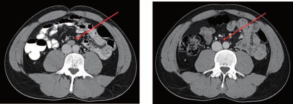 Figure 1. (A) Enlarged aortocaval lymph node at presentation. (B) Follow-up of the aortocaval lymph node at 15 months post proton beam therapy.