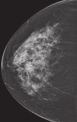 Technetium-99m Labeled Sestamibi Guided Stereotactic Breast Biopsy A Fig. 3 57-year-old woman (patient 9) with invasive ductal carcinoma.