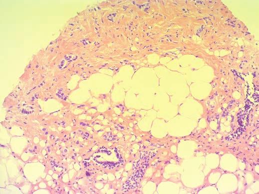 microcalcifications (invasive ductal carcinoma of no special type).