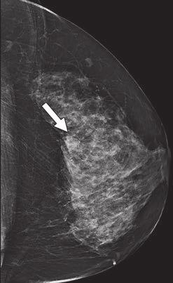 In our series, the correct clip position was verified using mammography, which was performed immediately after biopsy, revealing a success rate of 89%, which is similar to data reported by Liberman