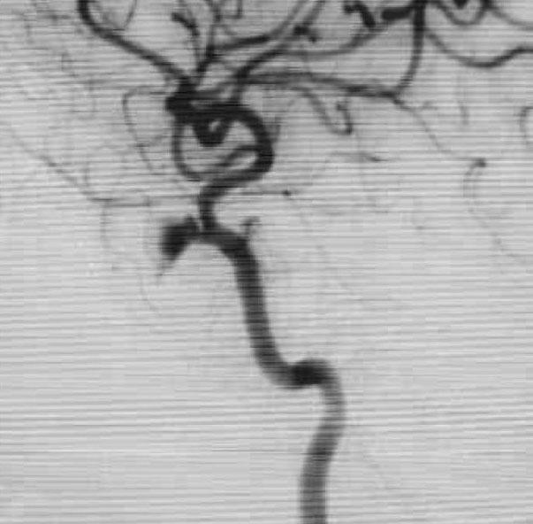 Traumatic Cerebral Pseudoaneurysms performed and the patient was discharged with no serious deficits.