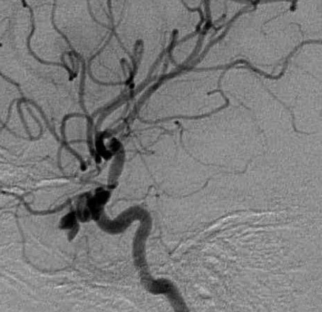After balloon occlusion was done as above, additional coil embolization of the middle meningeal artery was performed.