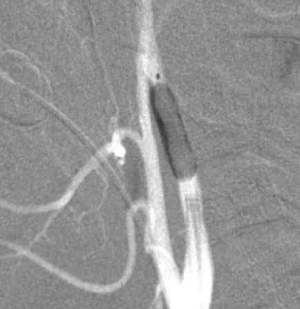 Upon postocclusion angiography, sufficient collateral circulation was identified and minimal retrograde filling of the pseudoaneurysm sac was seen.