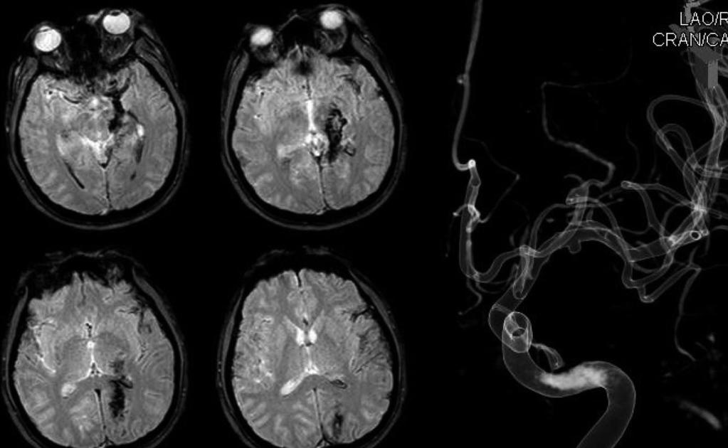 In case 7, the patient developed markedly progressing mental deterioration upon hospital arrival. Initially he was nearly alert, but was stuporous when the CT scan was taken.