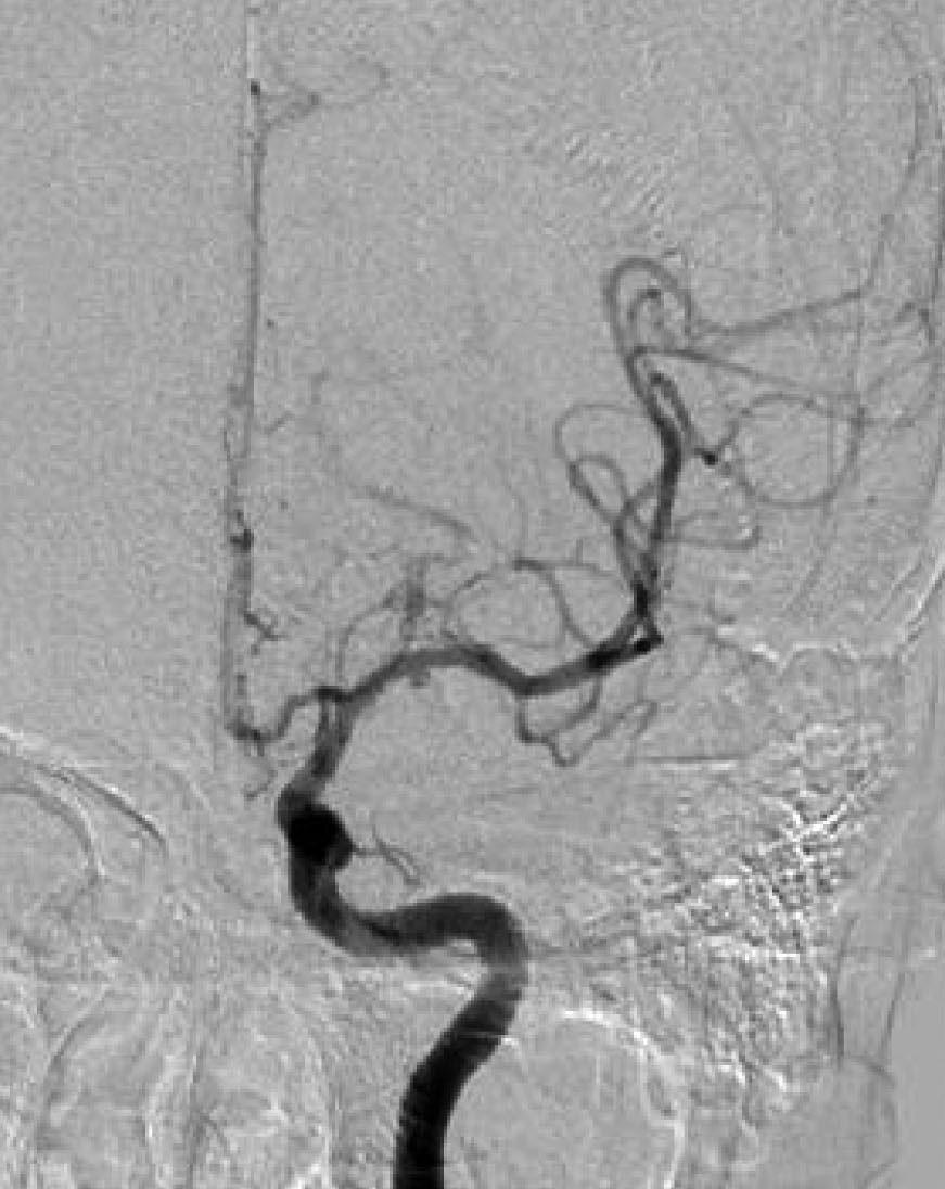 Traumatic Cerebral Pseudoaneurysms FIGURE 6. Initial and follow-up angiography of a middle cerebral artery pseudoaneurysm showing increase in size. clipping was done.