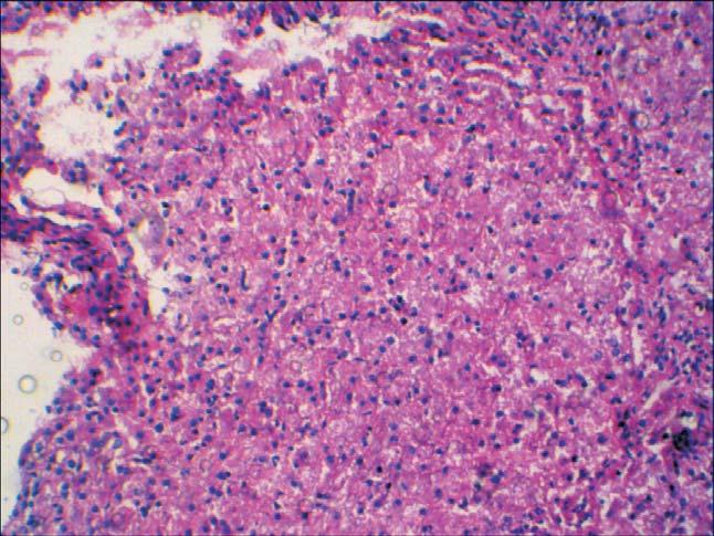 biopsy Liver biopsy sections from patients with type I glycogen